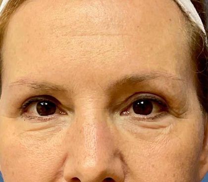 Eyelid Lift Before & After