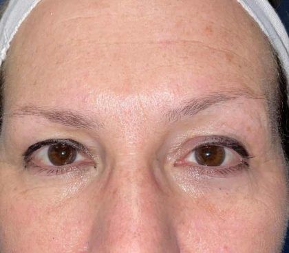 Eyelid Lift Before & After