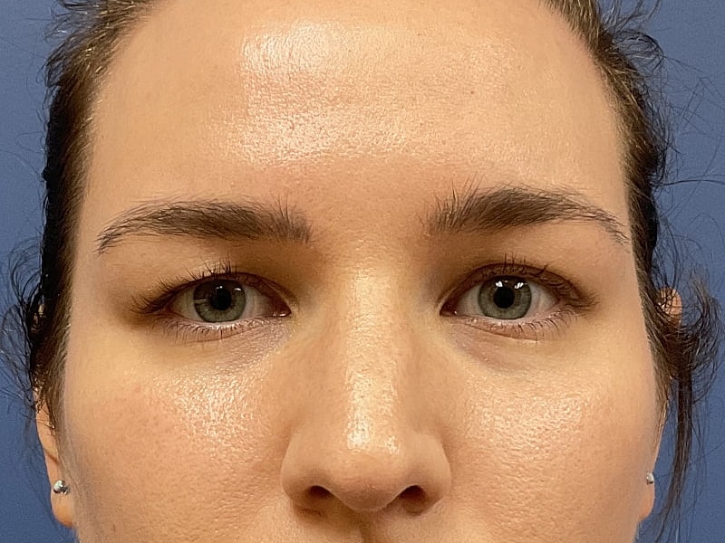 Eyelid Lift Before & After