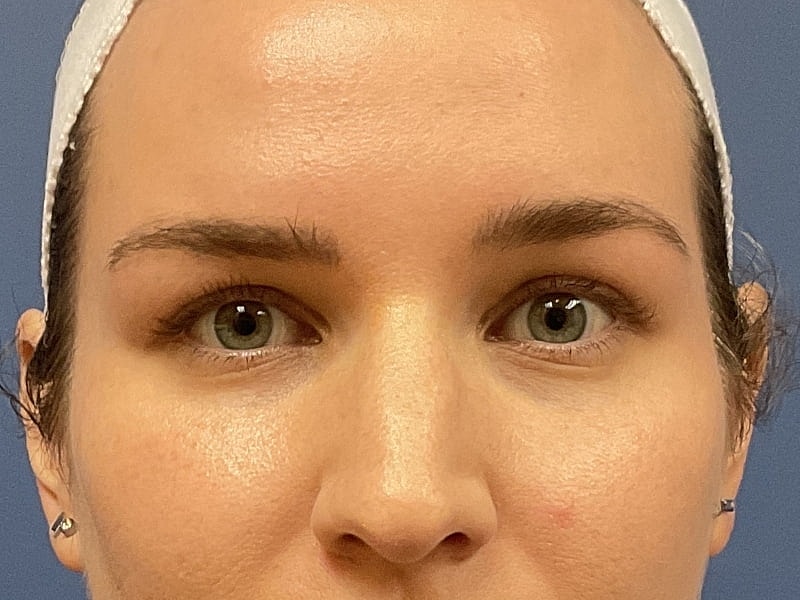 Eyelid Lift Before & After
