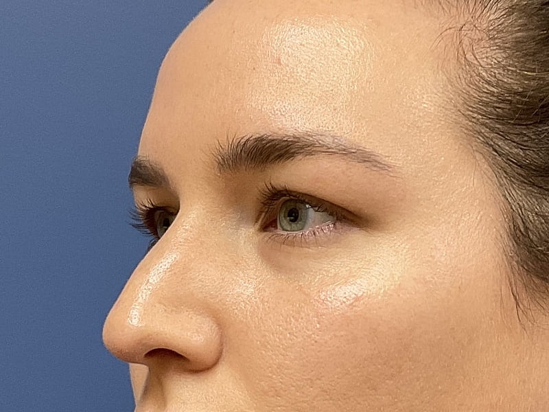 Eyelid Lift Before & After