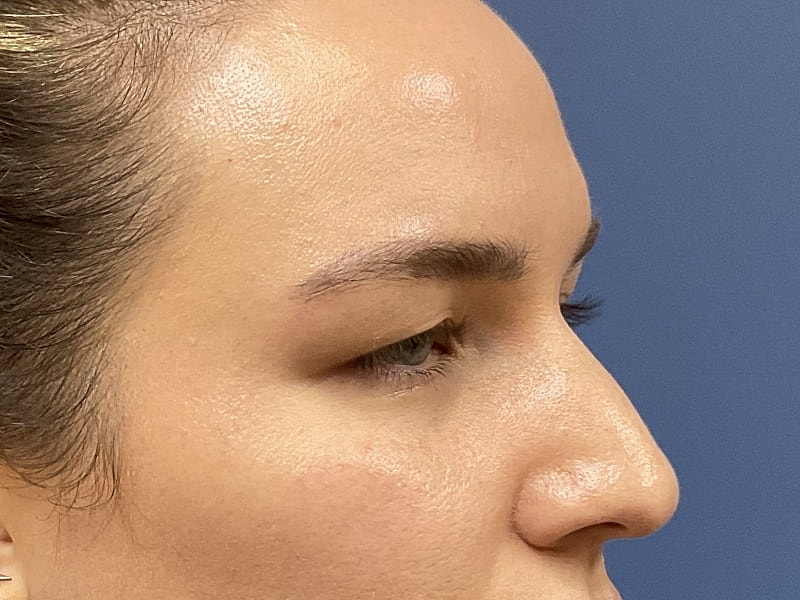 Eyelid Lift Before & After