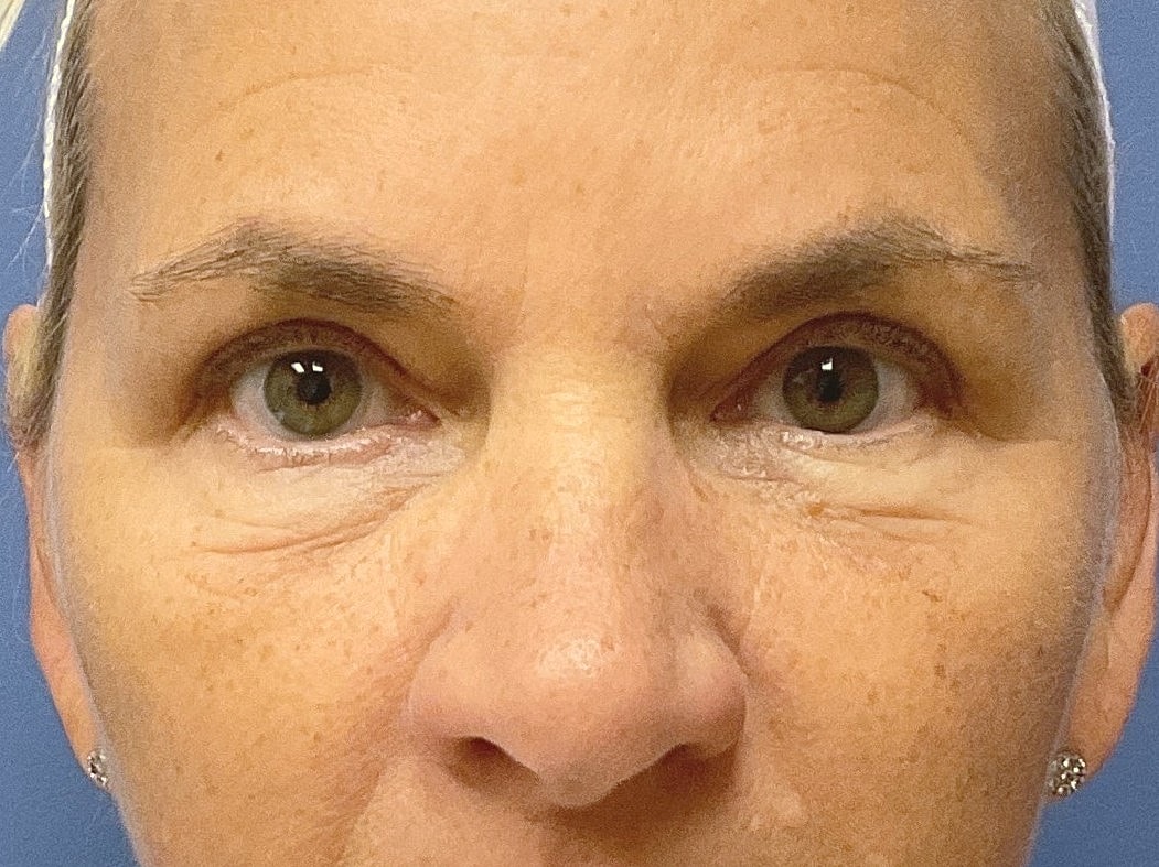 Eyelid Lift Before & After