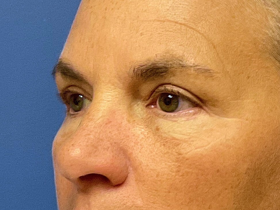 Eyelid Lift Before & After