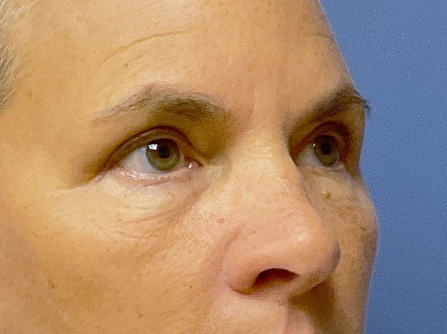 Eyelid Lift Before & After