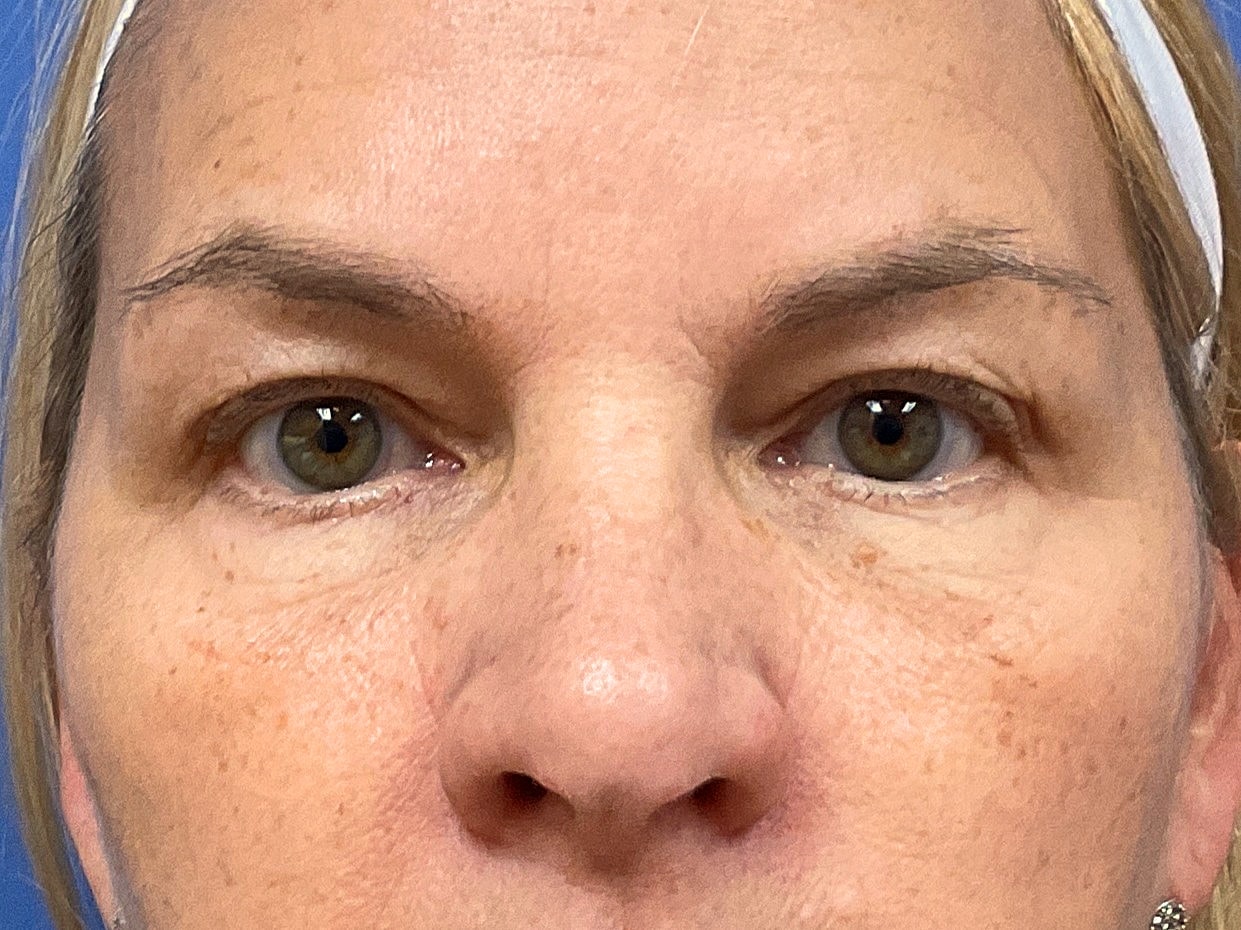 Eyelid Lift Before & After
