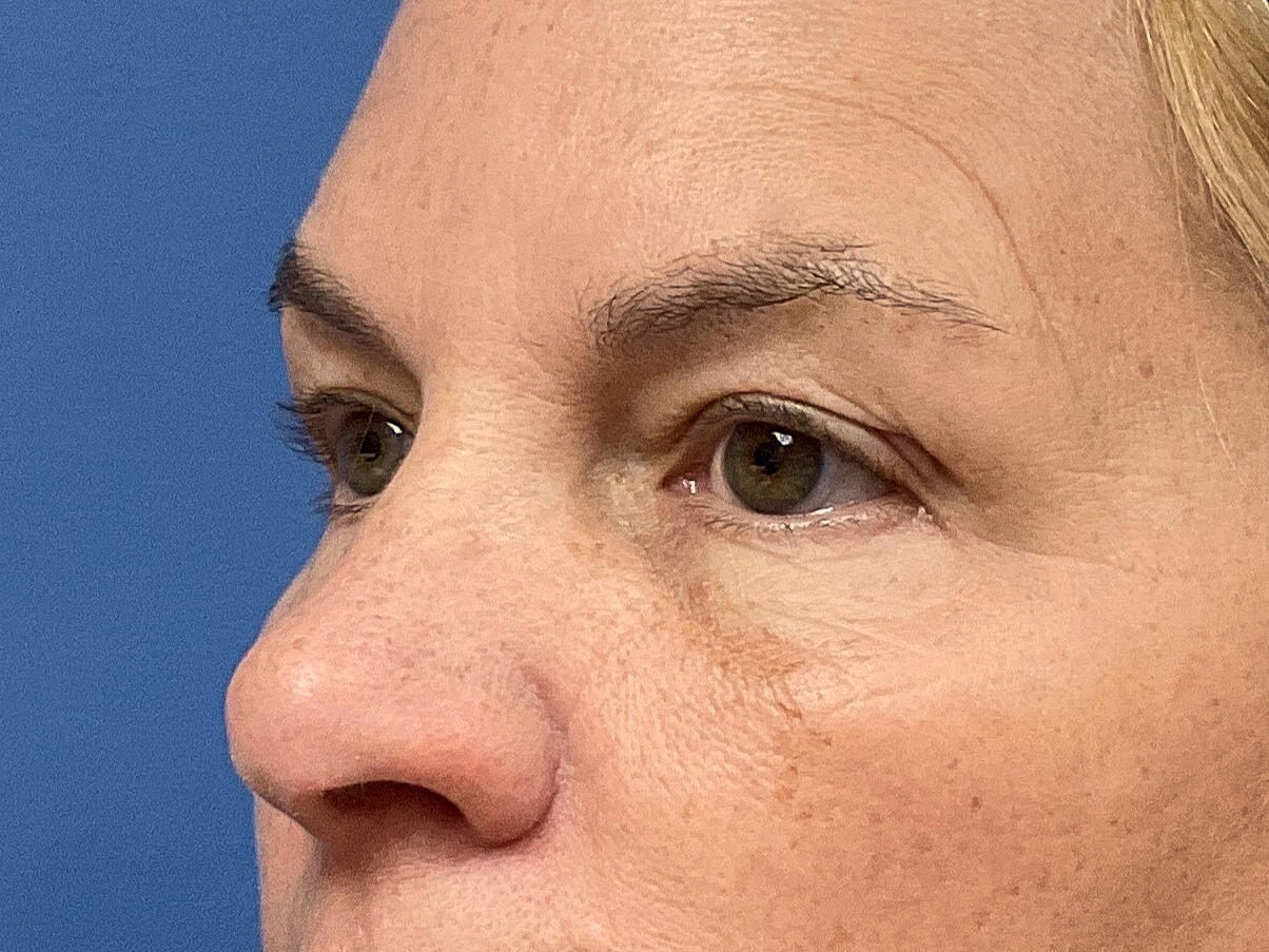 Eyelid Lift Before & After