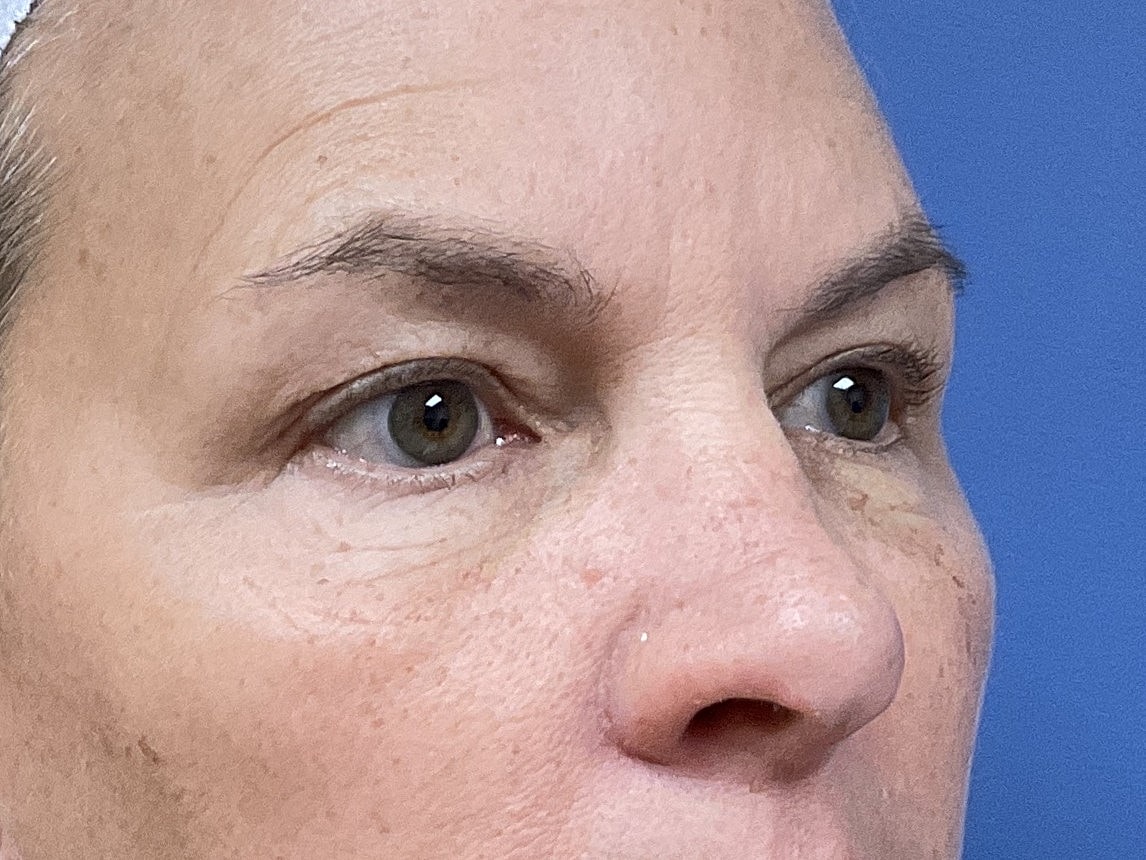 Eyelid Lift Before & After