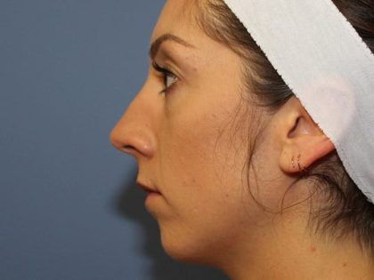 Rhinoplasty Before & After