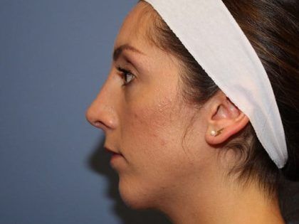 Rhinoplasty Before & After
