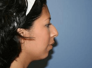 Rhinoplasty Before & After