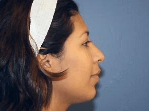 Rhinoplasty Before & After