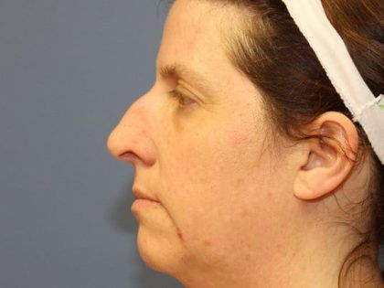 Rhinoplasty Before & After