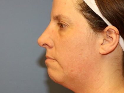 Rhinoplasty Before & After