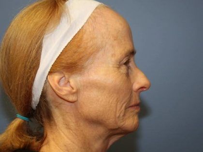 Rhinoplasty Before & After