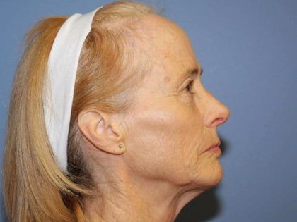 Rhinoplasty Before & After