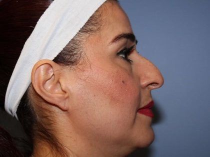 Rhinoplasty Before & After