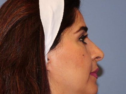 Rhinoplasty Before & After