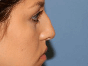 Rhinoplasty Before & After