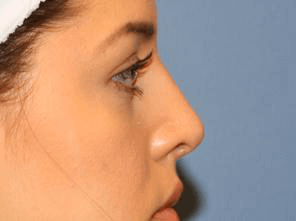 Rhinoplasty Before & After