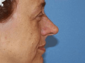 Rhinoplasty Before & After
