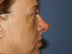 Rhinoplasty Before & After