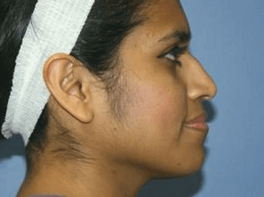 Rhinoplasty Before & After