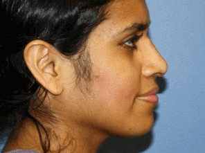 Rhinoplasty Before & After