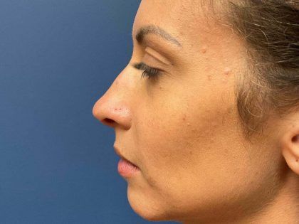 Rhinoplasty Before & After