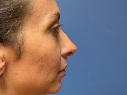 Rhinoplasty Before & After