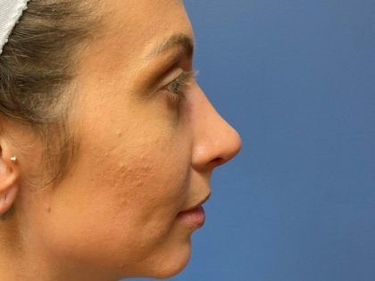 Rhinoplasty Before & After