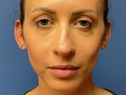 Rhinoplasty Before & After