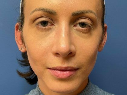 Rhinoplasty Before & After
