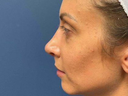 Rhinoplasty Before & After
