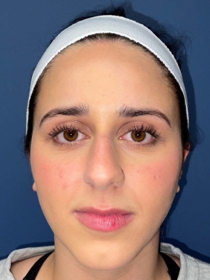 Rhinoplasty Before & After