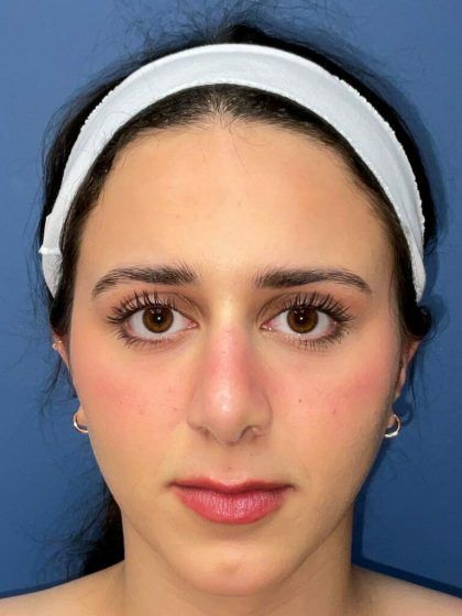 Rhinoplasty Before & After