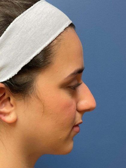 Rhinoplasty Before & After