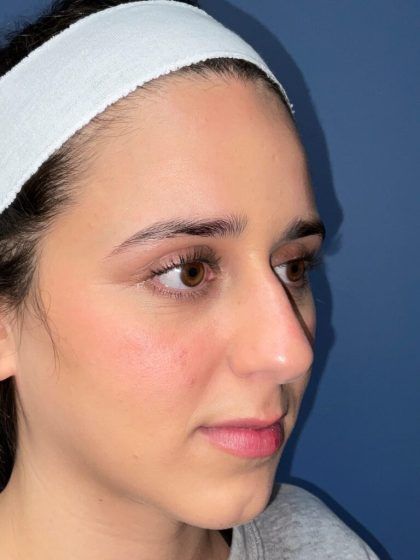 Rhinoplasty Before & After