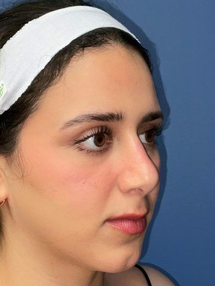 Rhinoplasty Before & After