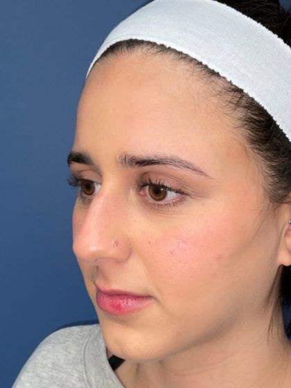 Rhinoplasty Before & After