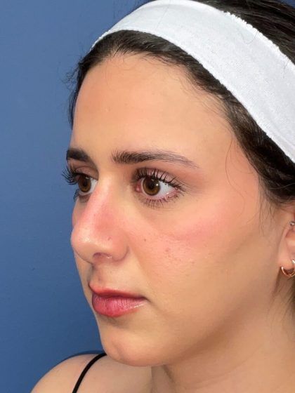 Rhinoplasty Before & After