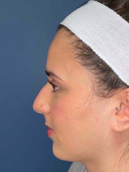 Rhinoplasty Before & After