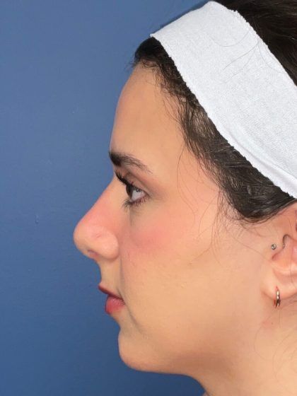 Rhinoplasty Before & After