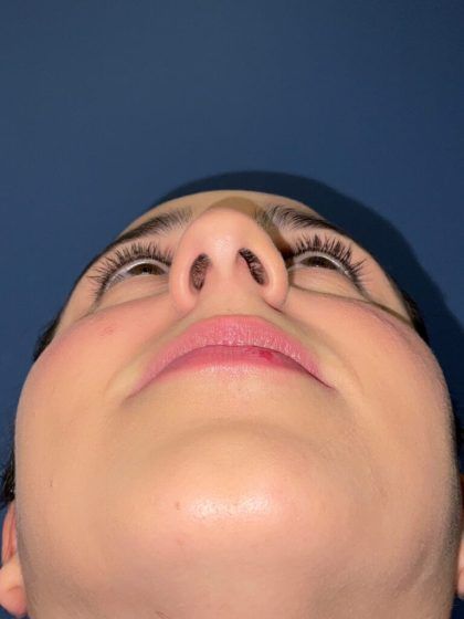 Rhinoplasty Before & After