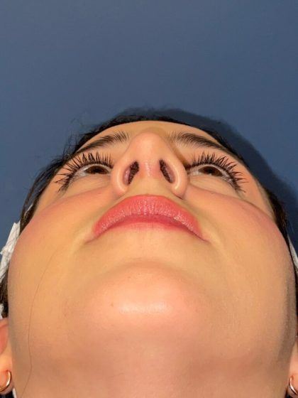 Rhinoplasty Before & After