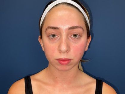 Rhinoplasty Before & After