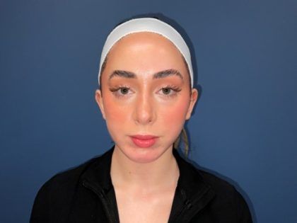 Rhinoplasty Before & After