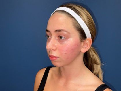 Rhinoplasty Before & After