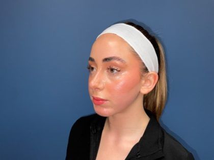 Rhinoplasty Before & After
