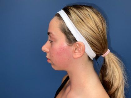 Rhinoplasty Before & After